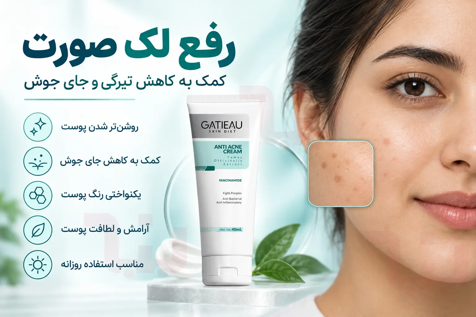 نوروژن برای مقابله با آکنه