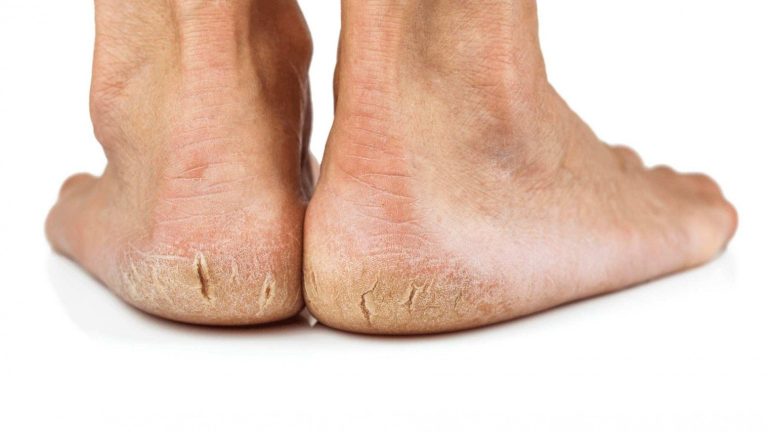 علت ترک پاشنه پا چیست؟ معرفی موثرترین درمان